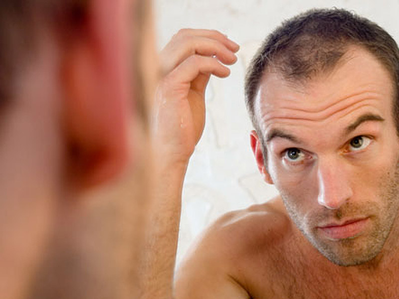 Erkeklerde Saç Kaybı Nasıl Önlenir?