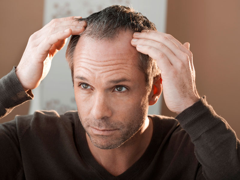 Erkeklerde Saç Kaybı Neden Olur?
