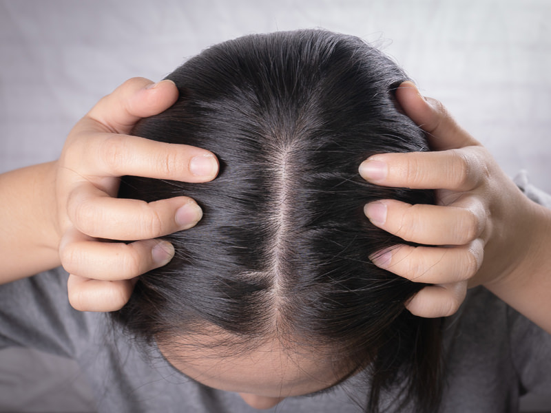 Kadınlarda Genetik Saç Kaybı - Akademi Saç Terapi