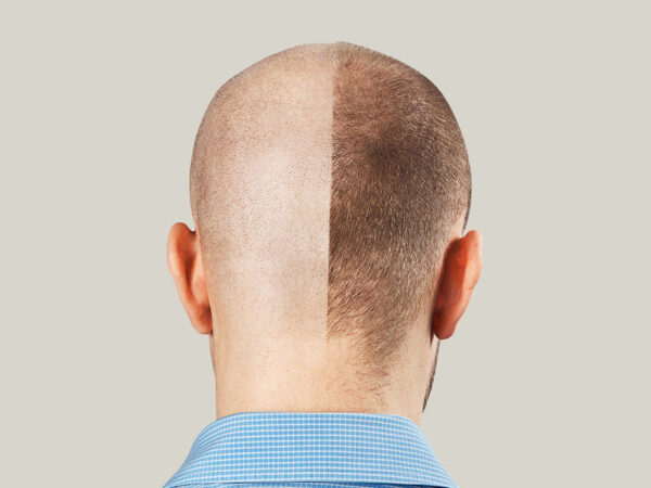 Saç Ekimi Nedir? Kimler İçin Uygundur? - Akademi Saç Terapi